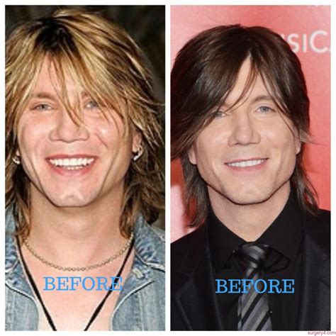 John Rzeznik Plastic Surgery Photos [Before & After] ⋆ Surgery4