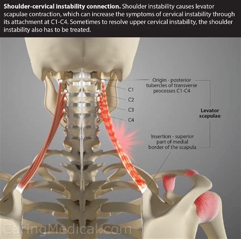 Is neck instability causing your shoulder pain?