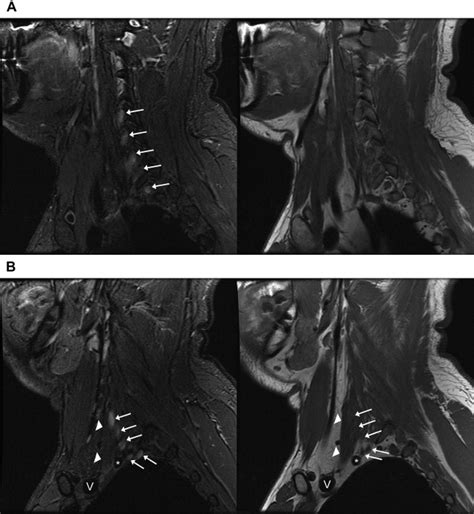 Brachial Plexus Sagittal Mri | Porn Sex Picture