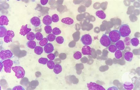 Bone marrow filled with blasts in acute lymphoblastic leukemia (ALL) patient 3