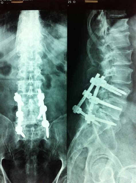 Spine fusion | Spinal fusion surgery, Spinal fusion, Injury recovery