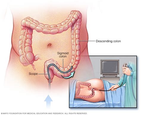 Sigmoidoscopy exam - Mayo Clinic