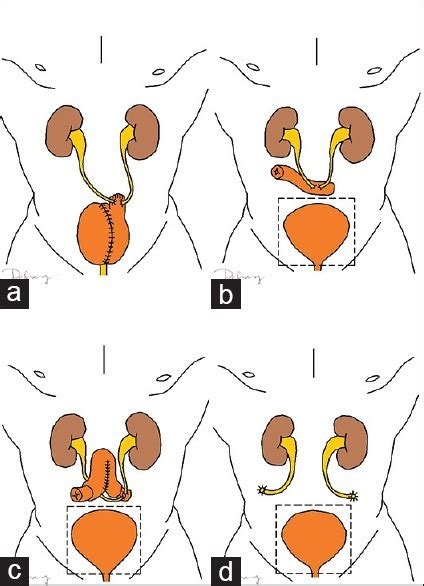 Urinary Diversion Types