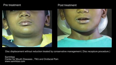 "Closed lock" of jaw treatment without surgery - YouTube