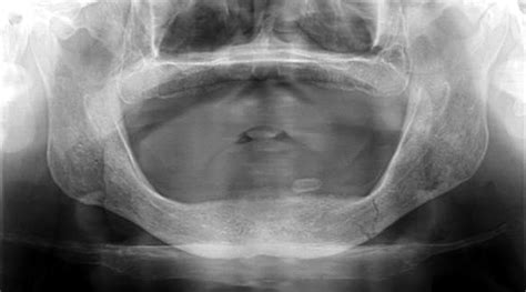 Preoperative panoramic x-ray depicting mandible fracture of left body... | Download Scientific ...