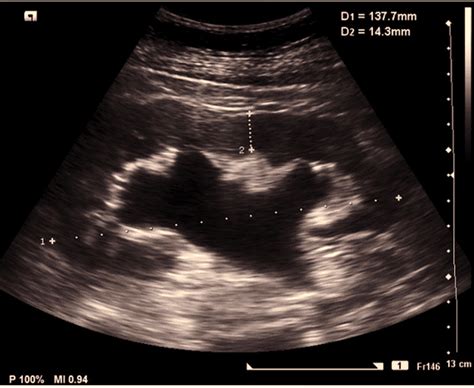 Moderate Hydronephrosis Ultrasound