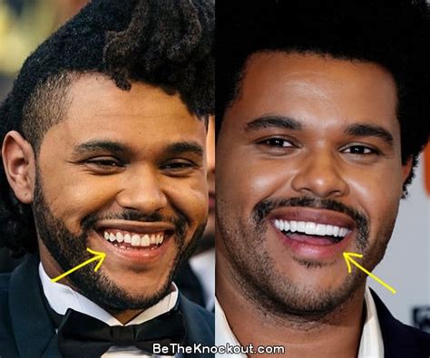 The Weeknd Plastic Surgery Comparison Photos