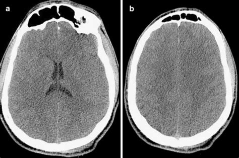 Diffuse cerebral swelling. (a) and (b) Axial noncontras | Open-i