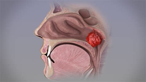 Adenoidectomy procedure to remove adenoid gland | Lymphatic & Endocrine ...