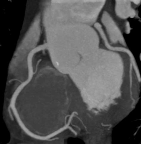 Cardiac CT - Coronary CT Angiography | Learn the Heart