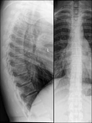 Mastering Thoracic Spine X-ray Interpretation: A Comprehensive Guide