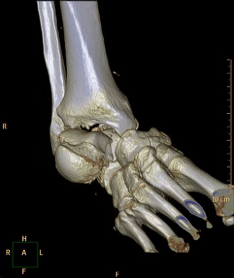 Medial subtalar dislocation with navicular and posterior talar process fracture: the first ...