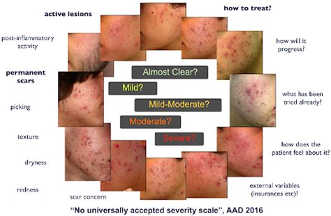 Encoding clinicians decision process in grading acne- severity scale - Computational Dermatology Lab