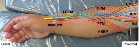 Preoperative ultrasound for runoff-venous decompression of peripheral ...