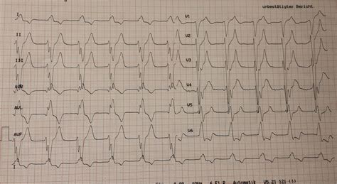 Dr. Smith's ECG Blog: A Very Wide Complex Tachycardia. What is the Rhythm? Use Lewis Leads!!