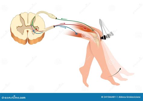 Knee Jerk or Patellar Tendon Reflex Stock Illustration - Illustration of patient, jerk: 241566481