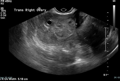 Ovarian Torsion | UAMS Department of Radiology