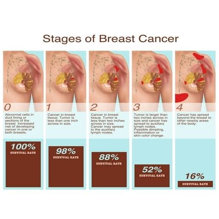 Breast Cancer Stages Illustration Poster Print by Gwen ShockeyScience ...