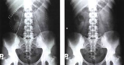 Abdomen Radiography - KUB : AP or PA Projection - RadTechOnDuty