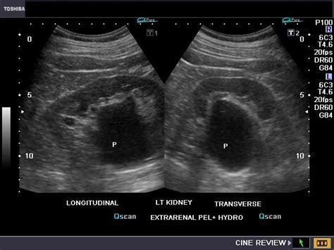 cochinblogs: Extrarenal pelvis: