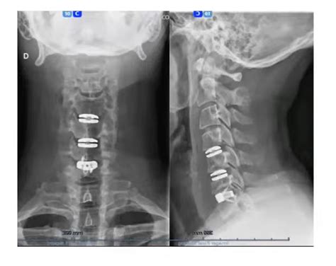 Degenerative Cervical Spine: Diagnosis and Management ...