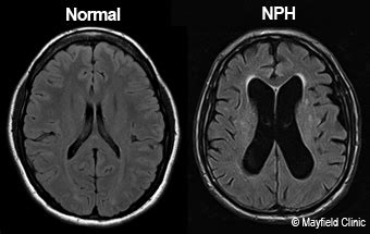 Normal Pressure Hydrocephalus