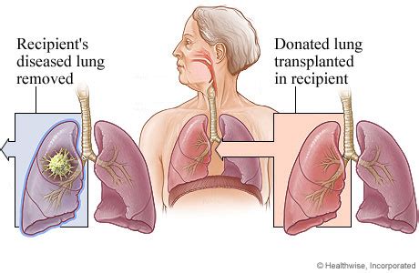 Lung Transplant Video & Image