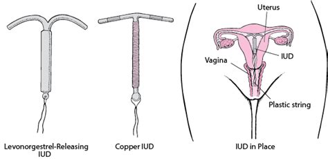 Quick Facts: Intrauterine Devices - MSD Manual Consumer Version