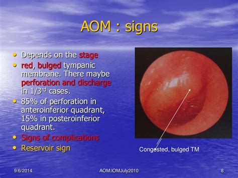 Acute Otitis Media