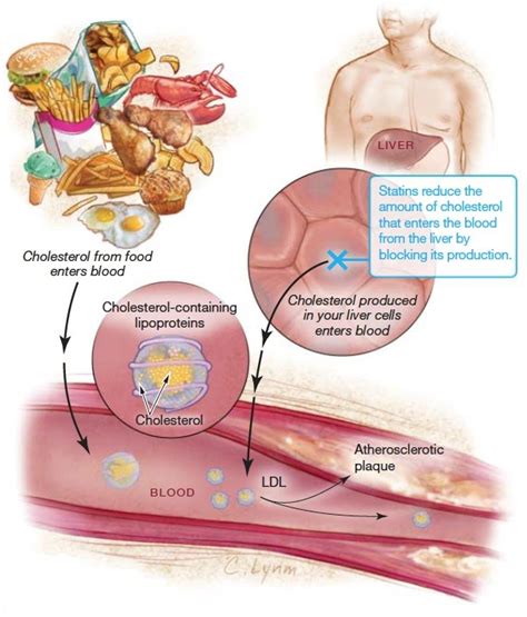 Should I be taking statins?