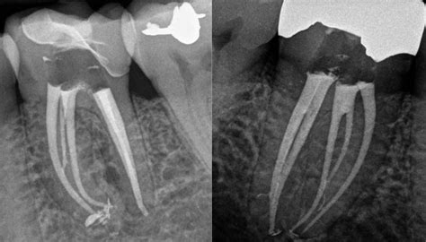 Root Canal Radiograph