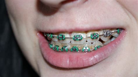 A Brief History of Braces - Curious Mind Magazine