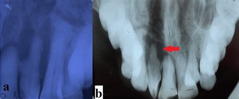 Intraoral periapical radiograph and occlusal radiograph. a: Intraoral... | Download Scientific ...