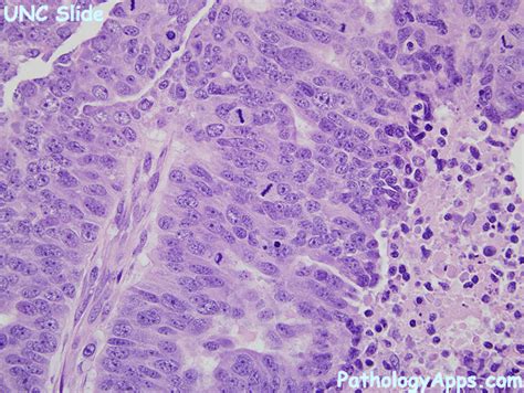 serous adenocarcinoma uterus histology