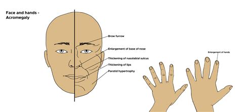 Acromegaly and Infertility: Causes, Symptoms, and Treatment Explained