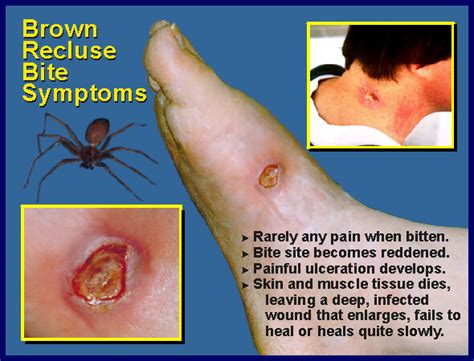 Brown Recluse Spider Bite Symptoms | Department of Entomology ...