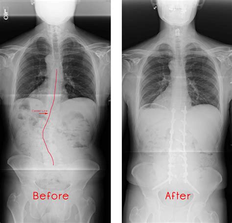 Scoliosis Front Before After