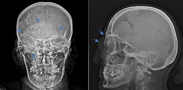 X-ray skull AP and lateral view showingexpansile osteolytic lesion with... | Download Scientific ...