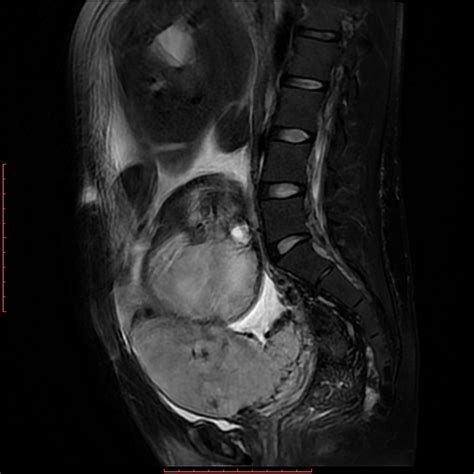 Placenta Accreta - Causes, Symptoms, Diagnosis, Risk Factors, Treatment