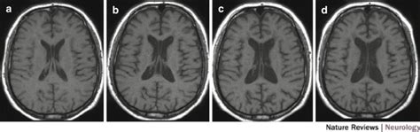 3 Brain atrophy in an MS patient (Figure 2 from [ 60 ] with original ...