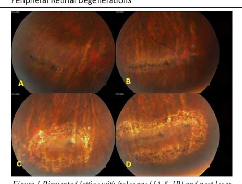 Figure 1 from Peripheral retinal degenerations. | Semantic Scholar