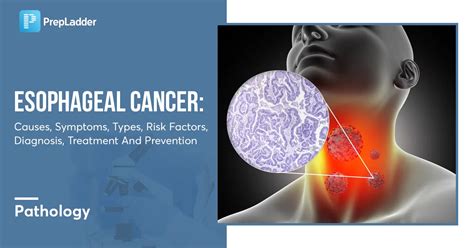 Esophageal Cancer: Causes, Symptoms, Types, Risk Factors, Diagnosis, Treatment, Prevention and ...