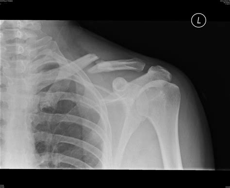 Collarbone surgery. Bones displacing after surgery? - Health & Fitness - ThumperTalk