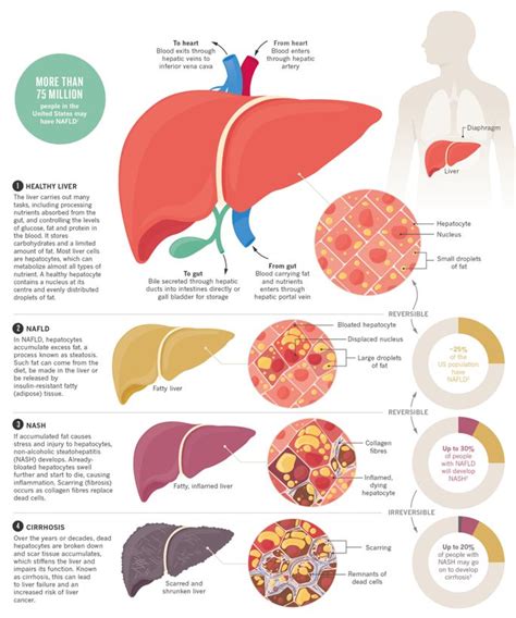 Liver Health, Best Fatty Liver Diet Plan And Exercises! - Veledora health