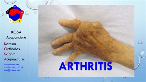 KOSA Acupuncture for Arthritis | KOSA Acupuncture