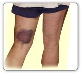 Hamstring Pull Diagnosis