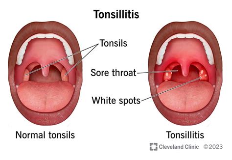 Tonsillitis: Symptoms, Causes Treatment, 46% OFF