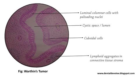 Dentosphere : World of Dentistry: Oral Pathology Histopathological ...