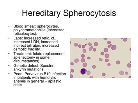 Hereditary Spherocytosis Causes Symptoms Treatment