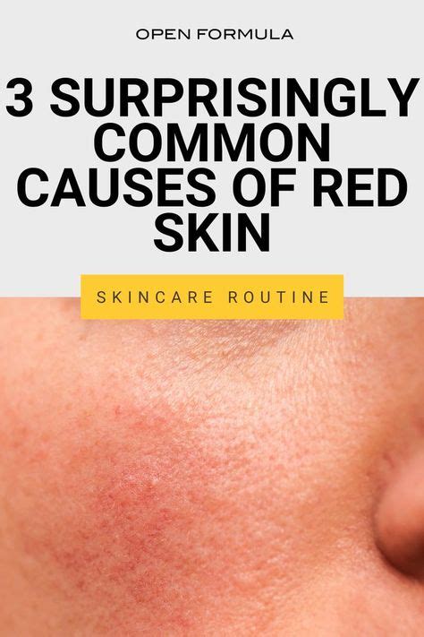 Do you know these three common causes of red skin? Here our tips for dealing with skin redness ...